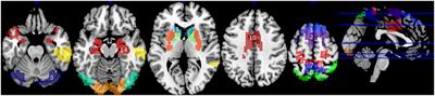 Why Is Aging a Risk Factor for Cognitive Impairment in Parkinson's Disease?—A Resting State fMRI Study